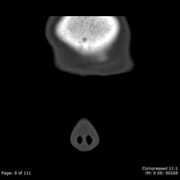 Right sided sinusitis on CT (right is left in Radiology Land)